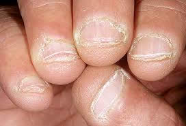 onicofagia, comerse las uñas compulsivamente